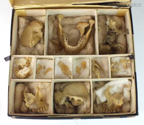 A complete disarticulated human skull, circa 1920s/30s