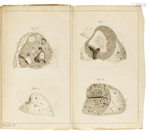 De l'auscultation mediate, ou traite du diagnostic des maladies des poumons et du coeur. Paris: J.A. Brosson & J.S. Chaudé, 1819. LAENNEC, RENÉ-THÉOPHILE-HYACINTHE. 1781-1826.