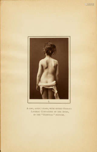 The Treatment of Lateral Curvature of the Spine, with an Appendix on the Treatment of Flat-Foot. London: H.K. Lewis, 1889. ROTH, BERNARD. ACTIVE 1880s.